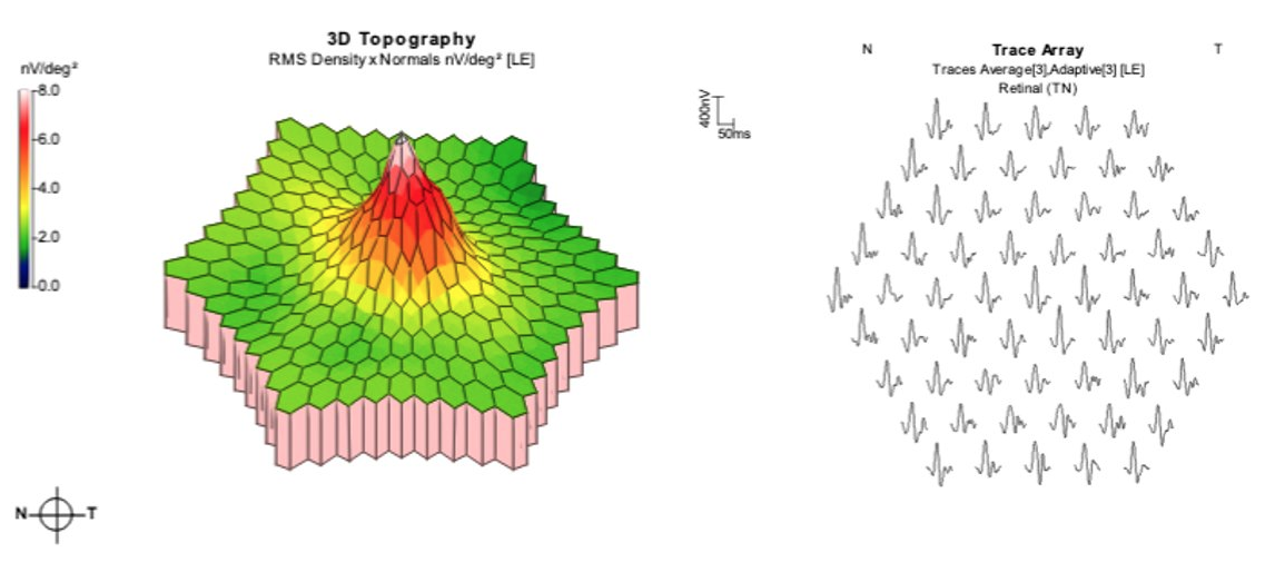 P505 - Párkinson a través del diagnósito Visual